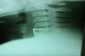 گرافی انجام شده در بیمارستان شهید بهشتی بندرانزلی